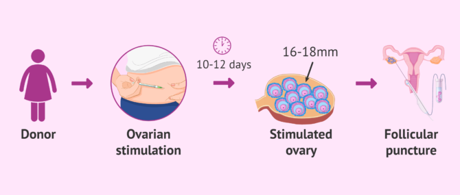 Imagen: Donor ovarian stimulation process