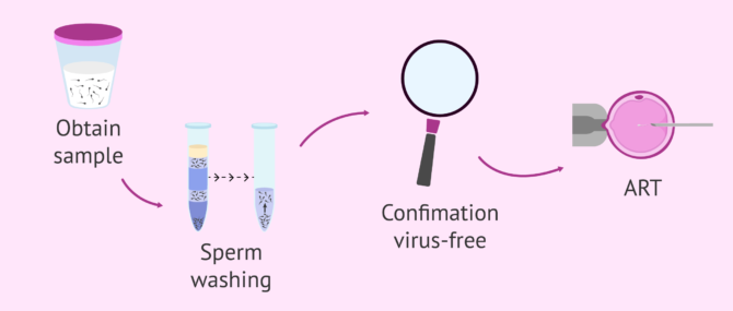 Imagen: Sperm washing procedure and confirmation of absence of viral