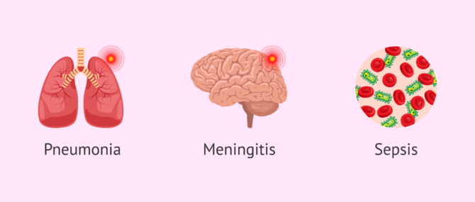 Imagen: Streptococcus B risks in new born babies