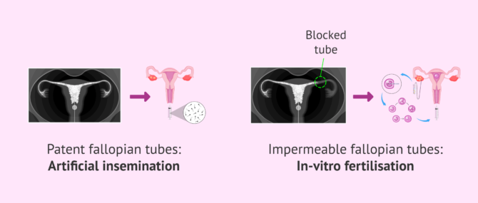 Imagen: Fertility treatment based on HSG result