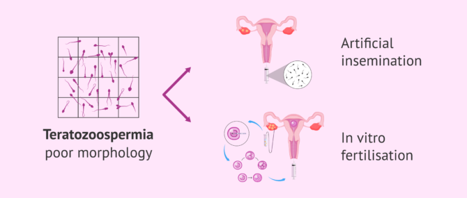 Imagen: Treatment options for achieving pregnancy with poor sperm morphology